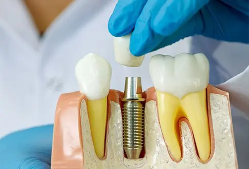 Dental Implant